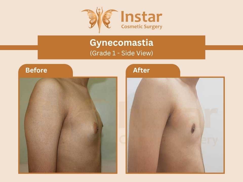 Gynecomastia (Grade 1 - Side View)